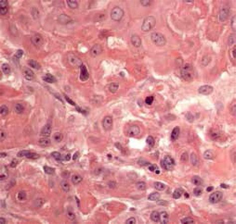 Scielo Brasil Squamoid Eccrine Ductal Carcinoma Squamoid Eccrine