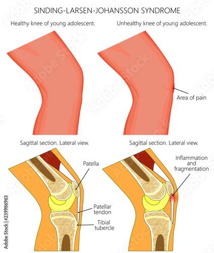 Vector Illustration Of A Healthy Adolescent Knee And Unhealthy Knee