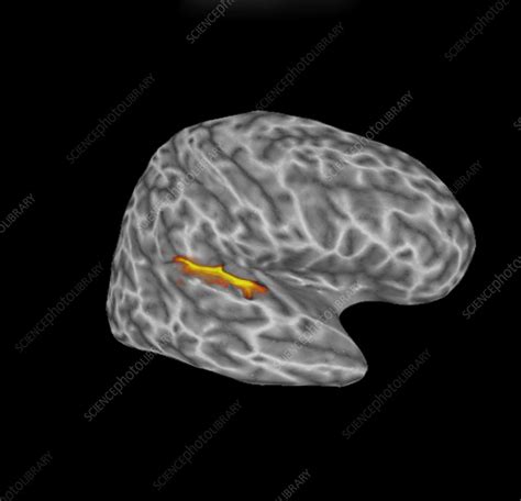 Functional MRI, auditory stimulus - Stock Image - C036/4989 - Science ...