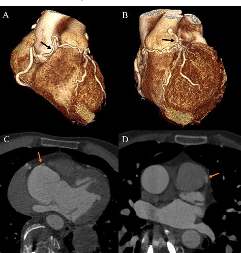 Figure 3 From Coexistence Of EhlersDanlos Syndrome With Coronary