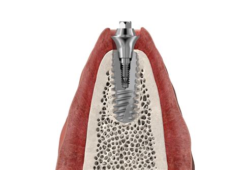 Axiom® Bone Level X3regpx Dental Implants Anthogyr