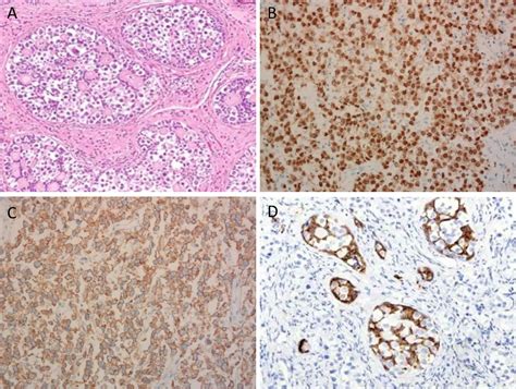 Frontiers Ovarian Gonadoblastoma With Dysgerminoma In A Girl With 46