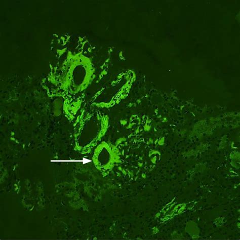 Aa Amyloidosis In Patient With Rheumatoid Arthritis Glomerulus And