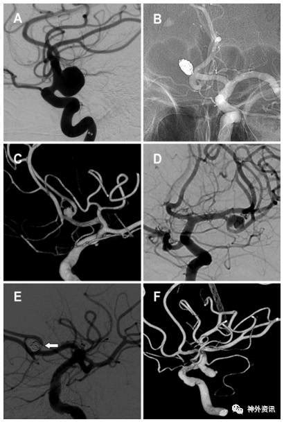 阿司匹林可降低破裂动脉瘤在栓塞治疗时发生动脉血栓栓塞的风险 脑医汇 神外资讯 神介资讯