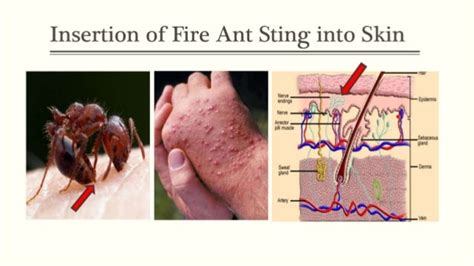 Fire Ant Stings Pathophysiology And Natural Remedy