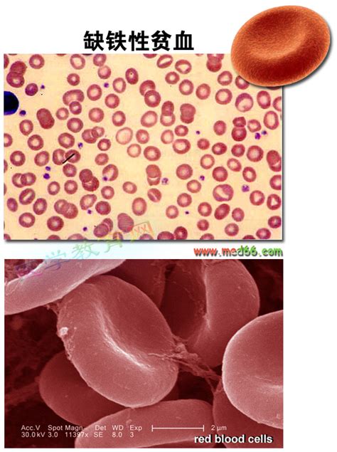 缺铁性贫血红细胞形态什么样 百度知道