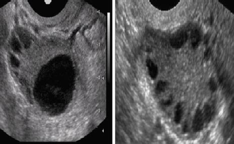 Polycystic Ovary Syndrome (PCOS) - Dr. Sita Sharma | MBBS, MD ...