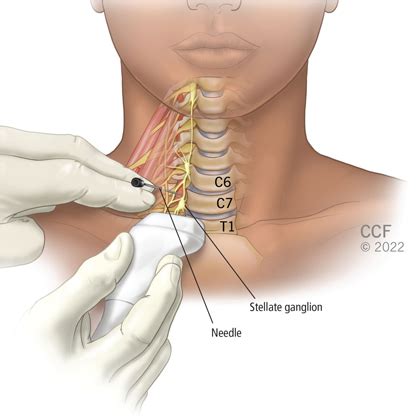 Best Stellate Ganglion Block Treatment In Mumbai | Axis Hospital