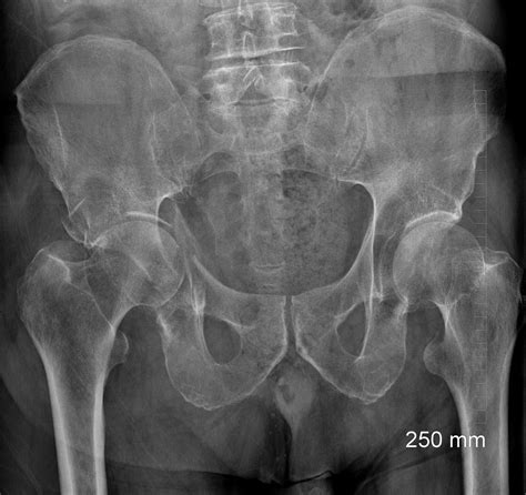 Hip Fracture Elderly