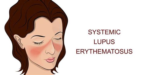 Rosacea Vs Lupus Butterfly Rash