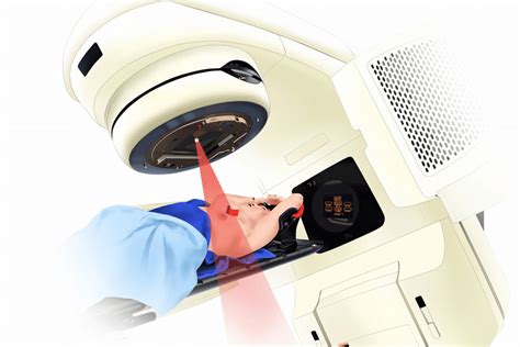 The Fov Field Of View Concept In Radiotherapy After Breast Cancer