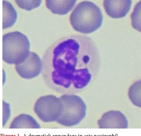 Figure 1 From Sex Chromatin In Peripheral Blood Neutrophils And Sex