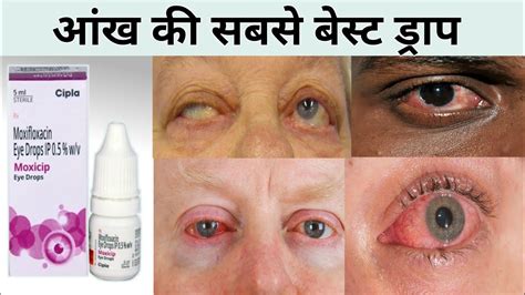 Moxicip Eye Drops In Hindi Moxifloxacin Eye Drops Uses Hindi Moxicip