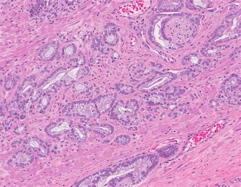 Adenocarcinoma - Prostate - MyPathologyReport.ca