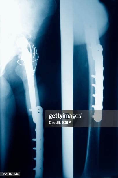 62 Coxarthrosis Stock Photos, High-Res Pictures, and Images - Getty Images