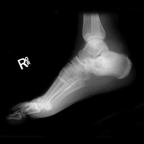 Chondroblastoma Calcaneum Image