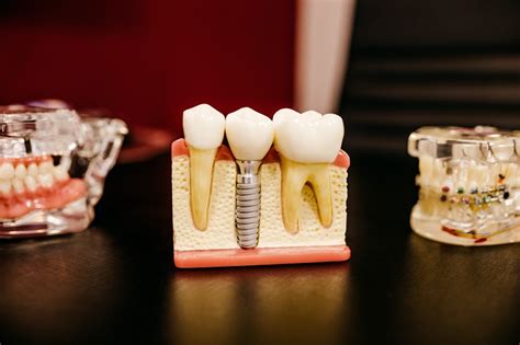 Read About Full Mouth Dental Implants New Columbia Dentistry