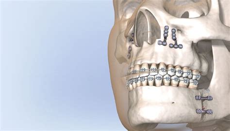 Understanding Orthognathic Surgery Decisions In Dentistry