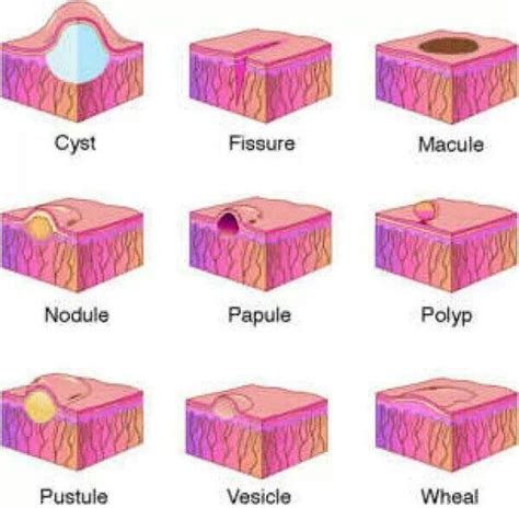 Types Of Lumps