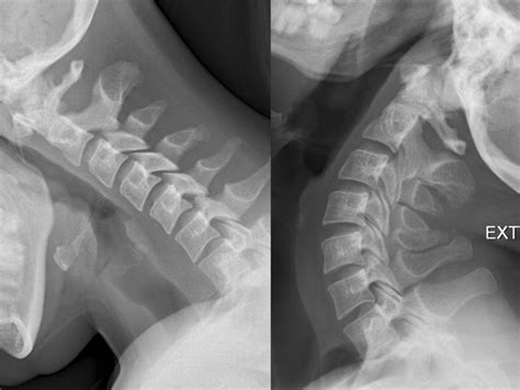 Atlantoaxial Instability