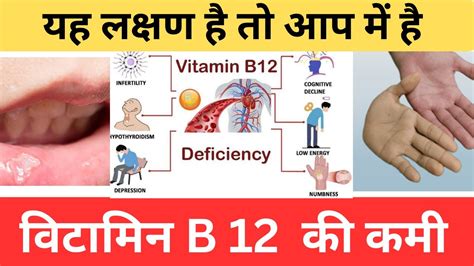 विटामिन B12 की कमी क्या आप खतरे में हैं 9 Symptoms Of Vitamin B12