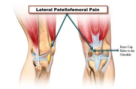 Types Of Knee Pain: Anterior, Posterior, Medial, Lateral, 48% OFF