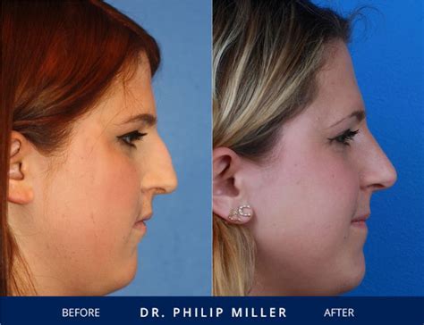 Does Health Insurance Cover Rhinoplasty In NYC Rhinoplasty