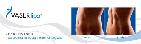 Lipo Vaser New Lo Nuevo En Liposucci N Centro De Cirug A Pl Stica Dr