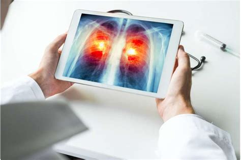 Lung Cancer Screening Guideline Nearly 5 Million US Adults Who Smoke