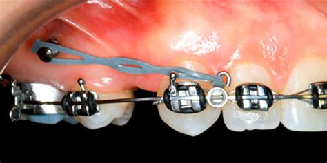 Microtornillos o microimplantes en ortodoncia qué son Ferrus Bratos