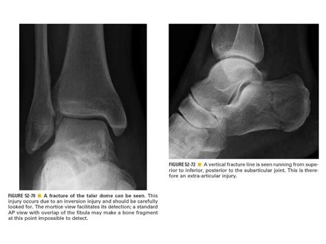 Skeletal trauma | PPT