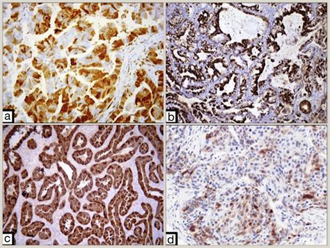 Interpretation Of P16 P53 And Mismatch Repair Protein Immunohistochemistry In Gynaecological