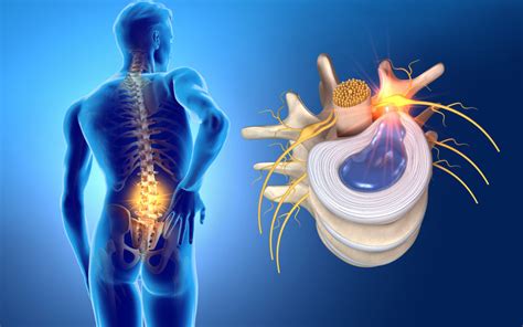 The Difference Sciatica Vs Herniated Discs | Performance Rehabilitation