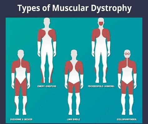 Muscular Dystrophy Symptoms Artofit