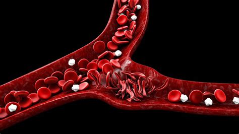 Diagn Stico E Tratamento Anemia Falciforme Cl Nica Pr Cura