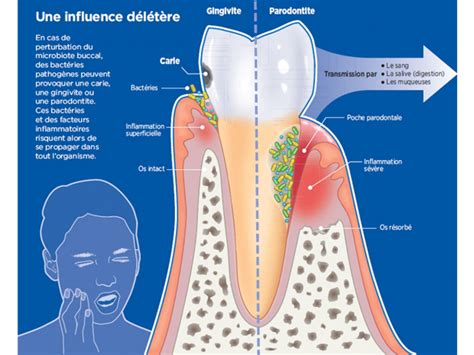 Gare Au D S Quilibre Du Microbiote Buccal Sciences Et Avenir