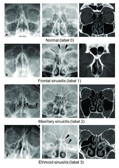 Representative Cases With Normal Label 0 A Frontal Sinusitis Label