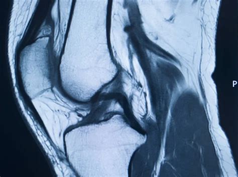 Knee injury mri mcl tear — Stock Photo © edwardolive #308025368