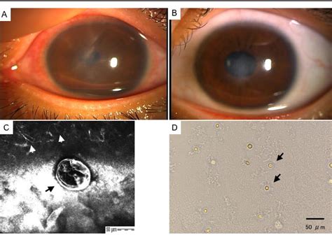 Figure 2 From The Application Of In Vivo Confocal Scanning Laser Microscopy In The Management Of