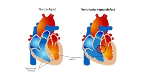 deconstructing congenital heart defects part ii blog