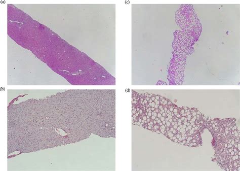 A Baseline Liver Biopsy Showing Very Mild Macrovescicular Steatosis 5 Download Scientific