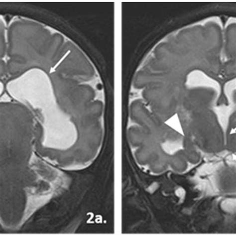 Coronal MRI Image at the Level of Body of Lateral Ventricles (A ...