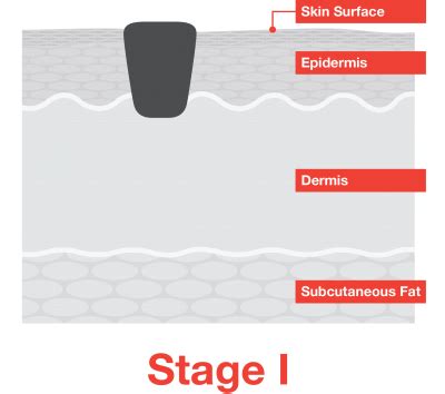 Stage 1 Melanoma - Melanoma Research Alliance