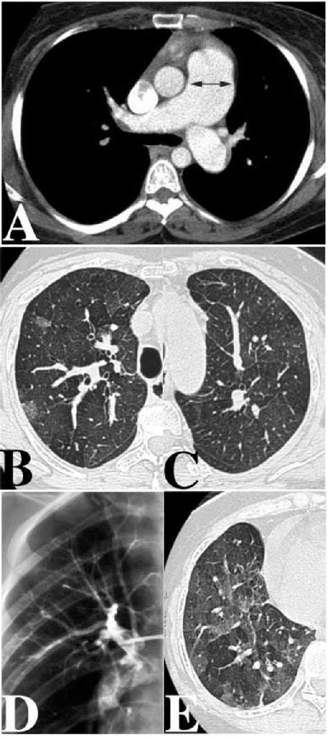 Figure 2 From Congenital Pulmonary Airway Malforma Tion—a New Name For And An Expanded