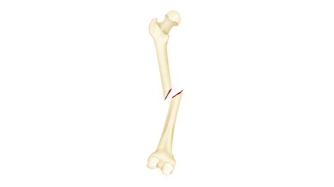Fracture Types, Causes Symptoms Britannica, 52% OFF