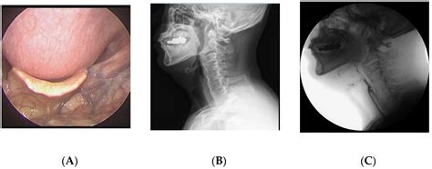 Medicina Free Full Text Surgical Treatment Of Dysphagia Secondary To Anterior Cervical