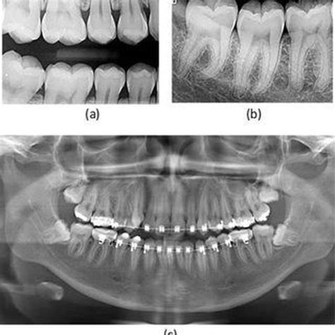 Bitewing Radiograph Uses MEDizzy