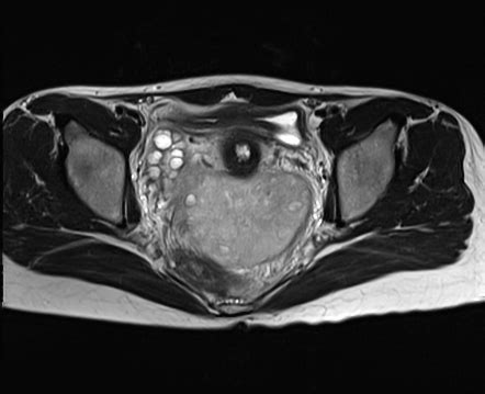 Ovarian Torsion Radiology Case Radiopaedia Org