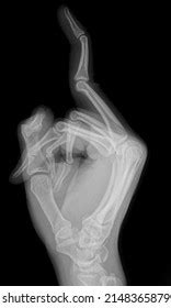 502 Middle Finger X Ray Images Stock Photos 3D Objects Vectors