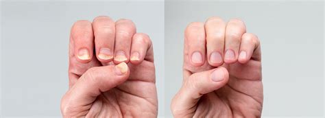 Nail Psoriasis vs. Fungus: Differences & Clinical Treatment Options